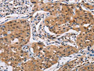 The image on the left is immunohistochemistry of paraffin-embedded Human lung cancer tissue using CSB-PA117532(PRKAA2 Antibody) at dilution 1/25, on the right is treated with fusion protein. (Original magnification: x200)