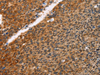 The image on the left is immunohistochemistry of paraffin-embedded Human liver cancer tissue using CSB-PA117532(PRKAA2 Antibody) at dilution 1/25, on the right is treated with fusion protein. (Original magnification: x200)