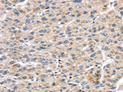 The image on the left is immunohistochemistry of paraffin-embedded Human liver cancer tissue using CSB-PA117539(LZTS1 Antibody) at dilution 1/20, on the right is treated with synthetic peptide. (Original magnification: x200)