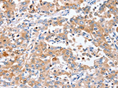 The image on the left is immunohistochemistry of paraffin-embedded Human liver cancer tissue using CSB-PA118443(PPOX Antibody) at dilution 1/40, on the right is treated with synthetic peptide. (Original magnification: x200)