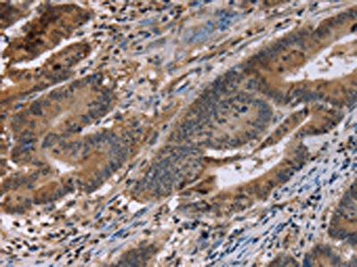 The image on the left is immunohistochemistry of paraffin-embedded Human colon cancer tissue using CSB-PA118886(FAM107A Antibody) at dilution 1/30, on the right is treated with fusion protein. (Original magnification: x200)