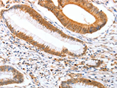 The image on the left is immunohistochemistry of paraffin-embedded Human colon cancer tissue using CSB-PA118910(DPPA2 Antibody) at dilution 1/25, on the right is treated with fusion protein. (Original magnification: x200)