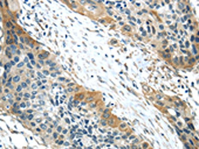 The image on the left is immunohistochemistry of paraffin-embedded Human esophagus cancer tissue using CSB-PA122476(VSIG10 Antibody) at dilution 1/35, on the right is treated with synthetic peptide. (Original magnification: x200)