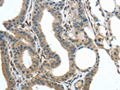 The image on the left is immunohistochemistry of paraffin-embedded Human thyroid cancer tissue using CSB-PA122476(VSIG10 Antibody) at dilution 1/35, on the right is treated with synthetic peptide. (Original magnification: x200)