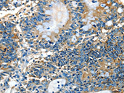 The image on the left is immunohistochemistry of paraffin-embedded Human colon cancer tissue using CSB-PA122487(ADCK4 Antibody) at dilution 1/25, on the right is treated with fusion protein. (Original magnification: x200)