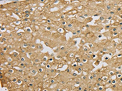 The image on the left is immunohistochemistry of paraffin-embedded Human prostate cancer tissue using CSB-PA122539(SERINC1 Antibody) at dilution 1/30, on the right is treated with synthetic peptide. (Original magnification: x200)