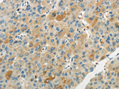 The image on the left is immunohistochemistry of paraffin-embedded Human liver cancer tissue using CSB-PA122866(WNT2B Antibody) at dilution 1/20, on the right is treated with synthetic peptide. (Original magnification: x200) The image on the left is immunohistochemistry of paraffin-embedded Human liver cancer tissue using CSB-PA122866(WNT2B Antibody) at dilution 1/20, on the right is treated with synthetic peptide. (Original magnification: x200)