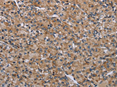 The image on the left is immunohistochemistry of paraffin-embedded Human prostate cancer tissue using CSB-PA123062(NLRP4 Antibody) at dilution 1/30, on the right is treated with synthetic peptide. (Original magnification: x200)