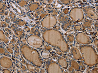 The image on the left is immunohistochemistry of paraffin-embedded Human thyroid cancer tissue using CSB-PA123062(NLRP4 Antibody) at dilution 1/30, on the right is treated with synthetic peptide. (Original magnification: x200)