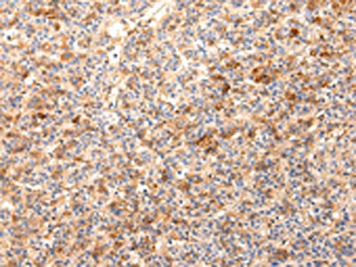 The image on the left is immunohistochemistry of paraffin-embedded Human liver cancer tissue using CSB-PA123199(ZNF365 Antibody) at dilution 1/20, on the right is treated with synthetic peptide. (Original magnification: x200)