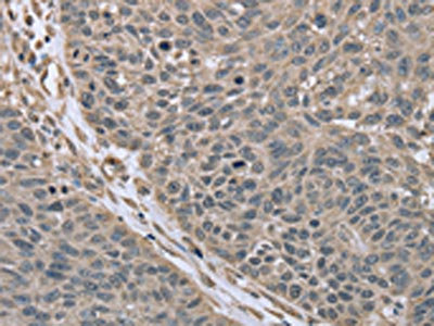 The image on the left is immunohistochemistry of paraffin-embedded Human lung cancer tissue using CSB-PA124825(RHEB Antibody) at dilution 1/40, on the right is treated with synthetic peptide. (Original magnification: x200)
