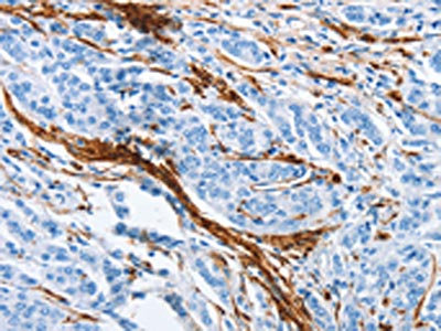 The image on the left is immunohistochemistry of paraffin-embedded Human prostate cancer tissue using CSB-PA125050(ACTA2 Antibody) at dilution 1/30, on the right is treated with synthetic peptide. (Original magnification: x200)