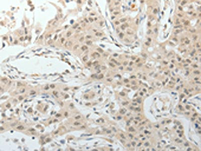 The image on the left is immunohistochemistry of paraffin-embedded Human lung cancer tissue using CSB-PA125082(TOP1MT Antibody) at dilution 1/15, on the right is treated with synthetic peptide. (Original magnification: x200)