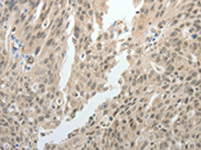 The image on the left is immunohistochemistry of paraffin-embedded Human ovarian cancer tissue using CSB-PA125082(TOP1MT Antibody) at dilution 1/15, on the right is treated with synthetic peptide. (Original magnification: x200)