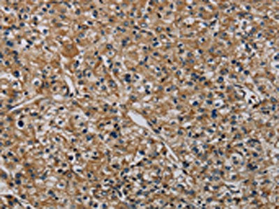 The image on the left is immunohistochemistry of paraffin-embedded Human prostate cancer tissue using CSB-PA126539(HSPG2 Antibody) at dilution 1/50, on the right is treated with synthetic peptide. (Original magnification: x200)