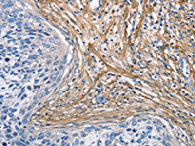 The image on the left is immunohistochemistry of paraffin-embedded Human cervical cancer tissue using CSB-PA127242(COL3A1 Antibody) at dilution 1/60, on the right is treated with fusion protein. (Original magnification: x200)