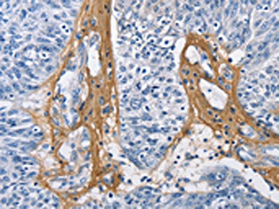 The image on the left is immunohistochemistry of paraffin-embedded Human ovarian cancer tissue using CSB-PA127242(COL3A1 Antibody) at dilution 1/60, on the right is treated with fusion protein. (Original magnification: x200)