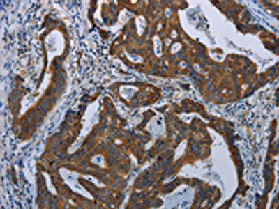 The image on the left is immunohistochemistry of paraffin-embedded Human gastric cancer tissue using CSB-PA127808(COX6B2 Antibody) at dilution 1/35, on the right is treated with fusion protein. (Original magnification: x200)