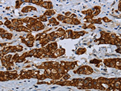 The image on the left is immunohistochemistry of paraffin-embedded Human breast cancer tissue using CSB-PA127808(COX6B2 Antibody) at dilution 1/35, on the right is treated with fusion protein. (Original magnification: x200)