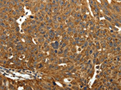 The image on the left is immunohistochemistry of paraffin-embedded Human ovarian cancer tissue using CSB-PA127898(EIF2AK3 Antibody) at dilution 1/40, on the right is treated with fusion protein. (Original magnification: x200)