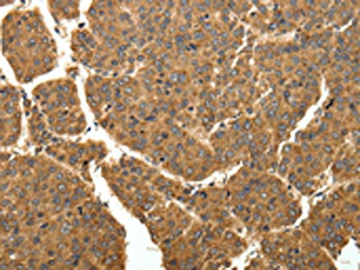 The image on the left is immunohistochemistry of paraffin-embedded Human liver cancer tissue using CSB-PA127898(EIF2AK3 Antibody) at dilution 1/40, on the right is treated with fusion protein. (Original magnification: x200)