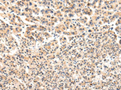 The image on the left is immunohistochemistry of paraffin-embedded Human liver cancer tissue using CSB-PA128038(VPS33A Antibody) at dilution 1/30, on the right is treated with fusion protein. (Original magnification: x200)