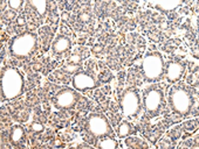 The image on the left is immunohistochemistry of paraffin-embedded Human thyroid cancer tissue using CSB-PA128038(VPS33A Antibody) at dilution 1/30, on the right is treated with fusion protein. (Original magnification: x200)
