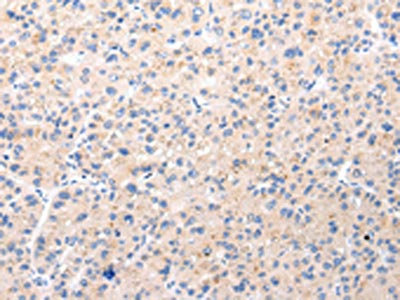 The image on the left is immunohistochemistry of paraffin-embedded Human liver cancer tissue using CSB-PA129979(BSN Antibody) at dilution 1/20, on the right is treated with synthetic peptide. (Original magnification: x200)