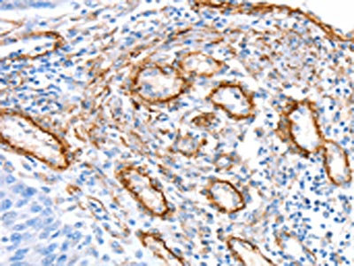 The image on the left is immunohistochemistry of paraffin-embedded Human lung cancer tissue using CSB-PA129980(SNX33 Antibody) at dilution 1/25, on the right is treated with synthetic peptide. (Original magnification: x200)