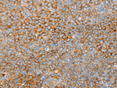 The image on the left is immunohistochemistry of paraffin-embedded Human ovarian cancer tissue using CSB-PA129980(SNX33 Antibody) at dilution 1/25, on the right is treated with synthetic peptide. (Original magnification: x200)