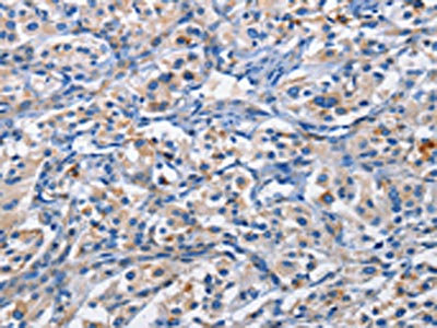 The image on the left is immunohistochemistry of paraffin-embedded Human thyroid cancer tissue using CSB-PA130040(PIM1 Antibody) at dilution 1/50, on the right is treated with fusion protein. (Original magnification: x200)