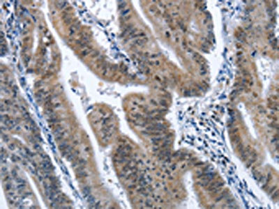 The image on the left is immunohistochemistry of paraffin-embedded Human colon cancer tissue using CSB-PA130108(CADM3 Antibody) at dilution 1/40, on the right is treated with fusion protein. (Original magnification: x200)