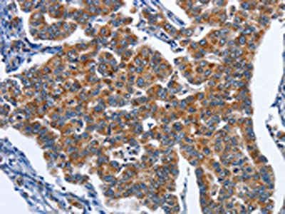 The image on the left is immunohistochemistry of paraffin-embedded Human breast cancer tissue using CSB-PA130108(CADM3 Antibody) at dilution 1/40, on the right is treated with fusion protein. (Original magnification: x200)