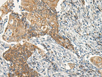 The image on the left is immunohistochemistry of paraffin-embedded Human cervical cancer tissue using CSB-PA130147(VIPR2 Antibody) at dilution 1/35, on the right is treated with synthetic peptide. (Original magnification: x200)