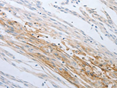 The image on the left is immunohistochemistry of paraffin-embedded Human cervical cancer tissue using CSB-PA130669(LOX Antibody) at dilution 1/30, on the right is treated with synthetic peptide. (Original magnification: x200)