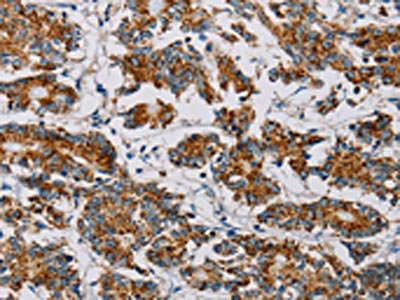 The image on the left is immunohistochemistry of paraffin-embedded Human colon cancer tissue using CSB-PA132736(MTFP1 Antibody) at dilution 1/20, on the right is treated with fusion protein. (Original magnification: x200)