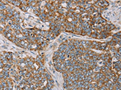 The image on the left is immunohistochemistry of paraffin-embedded Human cervical cancer tissue using CSB-PA132736(MTFP1 Antibody) at dilution 1/20, on the right is treated with fusion protein. (Original magnification: x200)