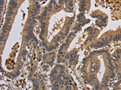 The image on the left is immunohistochemistry of paraffin-embedded Human colon cancer tissue using CSB-PA133169(KCNA7 Antibody) at dilution 1/40, on the right is treated with synthetic peptide. (Original magnification: x200)