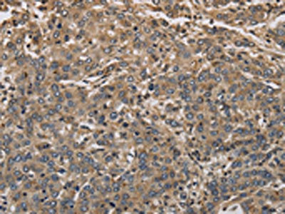 The image on the left is immunohistochemistry of paraffin-embedded Human liver cancer tissue using CSB-PA133169(KCNA7 Antibody) at dilution 1/40, on the right is treated with synthetic peptide. (Original magnification: x200)