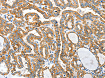 The image on the left is immunohistochemistry of paraffin-embedded Human thyroid cancer tissue using CSB-PA133590(CKAP4 Antibody) at dilution 1/50, on the right is treated with synthetic peptide. (Original magnification: x200)