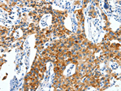 The image on the left is immunohistochemistry of paraffin-embedded Human lung cancer tissue using CSB-PA133590(CKAP4 Antibody) at dilution 1/50, on the right is treated with synthetic peptide. (Original magnification: x200)