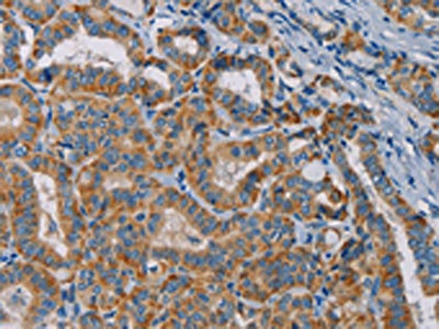 The image is immunohistochemistry of paraffin-embedded Human thyroid cancer tissue using CSB-PA133615(TAB3 Antibody) at dilution 1/25. (Original magnification: x200)