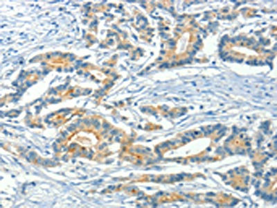 The image on the left is immunohistochemistry of paraffin-embedded Human colon cancer tissue using CSB-PA133826(ASAH2 Antibody) at dilution 1/50, on the right is treated with fusion protein. (Original magnification: x200)