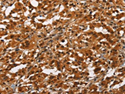 The image on the left is immunohistochemistry of paraffin-embedded Human thyroid cancer tissue using CSB-PA135409(ANAPC4 Antibody) at dilution 1/50, on the right is treated with synthetic peptide. (Original magnification: x200) The image on the left is immunohistochemistry of paraffin-embedded Human thyroid cancer tissue using CSB-PA135409(ANAPC4 Antibody) at dilution 1/50, on the right is treated with synthetic peptide. (Original magnification: x200)