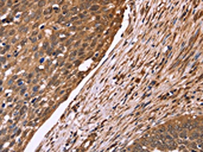 The image on the left is immunohistochemistry of paraffin-embedded Human cervical cancer tissue using CSB-PA136079(CDC37L1 Antibody) at dilution 1/50, on the right is treated with fusion protein. (Original magnification: x200)