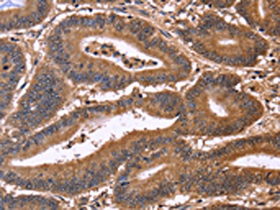 The image on the left is immunohistochemistry of paraffin-embedded Human colon cancer tissue using CSB-PA136079(CDC37L1 Antibody) at dilution 1/50, on the right is treated with fusion protein. (Original magnification: x200)