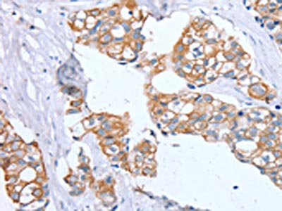 The image on the left is immunohistochemistry of paraffin-embedded Human breast cancer tissue using CSB-PA137436(PTP4A2 Antibody) at dilution 1/30, on the right is treated with synthetic peptide. (Original magnification: x200)
