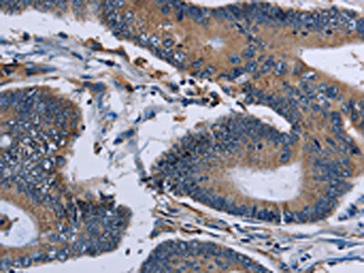 The image on the left is immunohistochemistry of paraffin-embedded Human colon cancer tissue using CSB-PA137528(IPO4 Antibody) at dilution 1/50, on the right is treated with fusion protein. (Original magnification: x200)