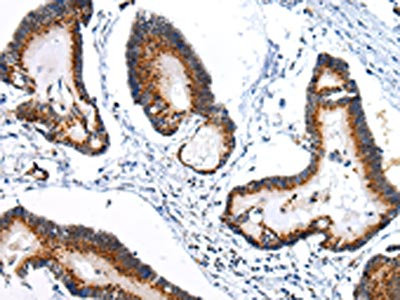 The image on the left is immunohistochemistry of paraffin-embedded Human colorectal cancer tissue using CSB-PA137594(ARFGAP2 Antibody) at dilution 1/25, on the right is treated with synthetic peptide. (Original magnification: x200)