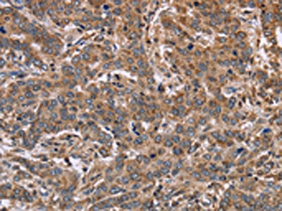 The image on the left is immunohistochemistry of paraffin-embedded Human liver cancer tissue using CSB-PA139252(FAAH2 Antibody) at dilution 1/30, on the right is treated with fusion protein. (Original magnification: x200)